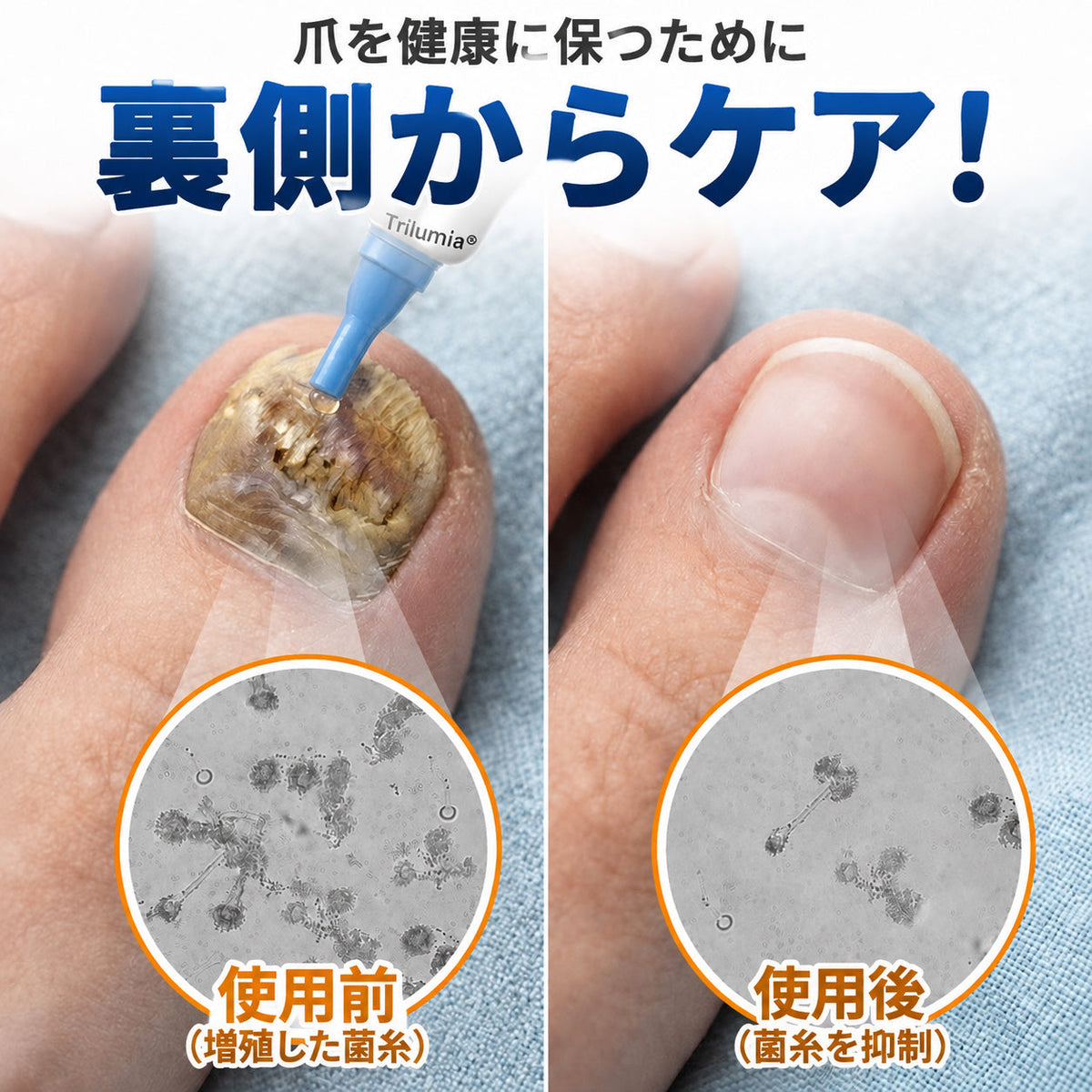 🇯🇵 Trilumia® Fungi Free ビーベノム ネイルトリートメント 👨‍⚕️ – わずか7日で目に見える変化を実感