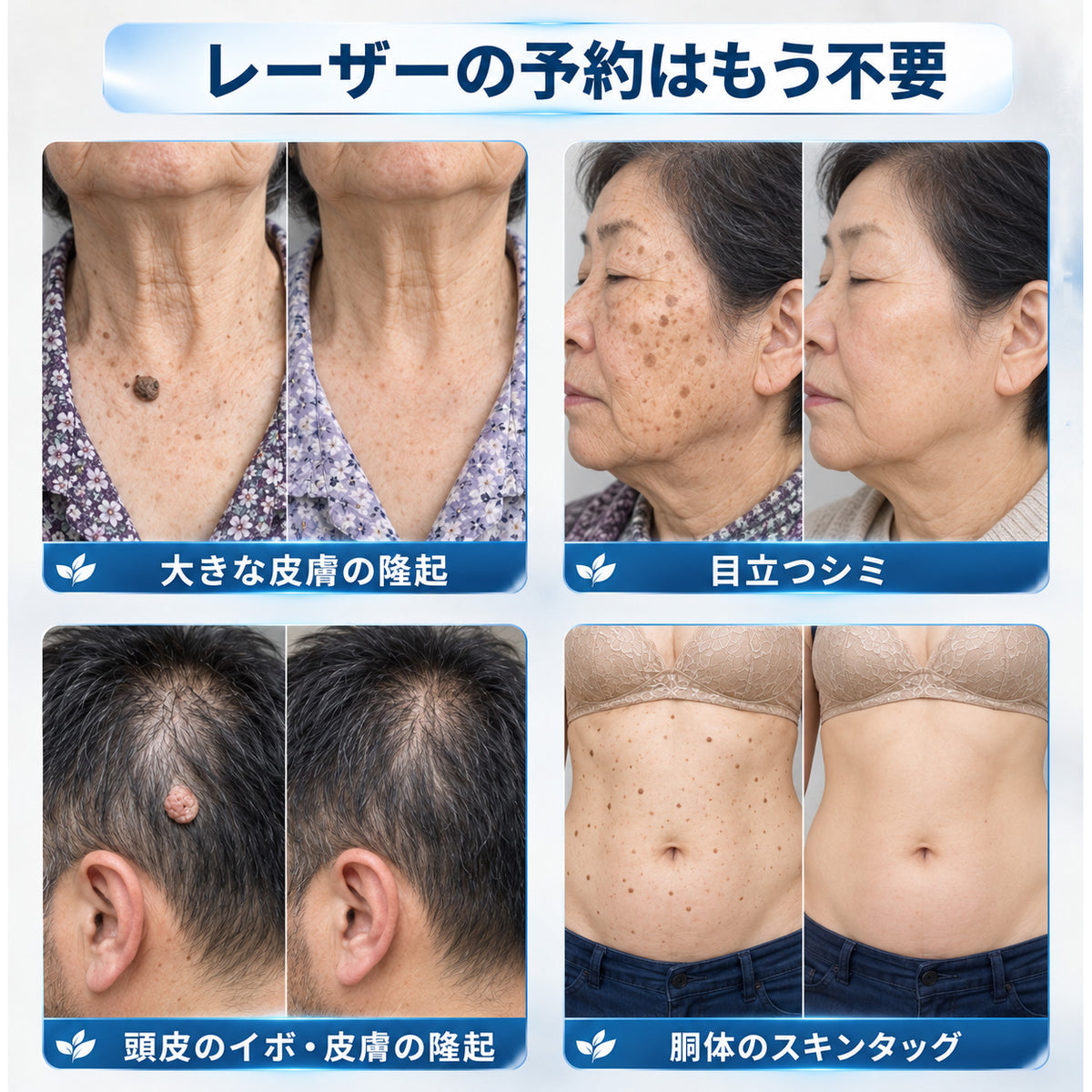 ✨ 70%OFF｜CUREVIVO® 公式ストア🛡️｜7日間 スキンタッグ・気になる黒ずみ集中ケアクリーム｜GMP認証工場製造・植物由来処方