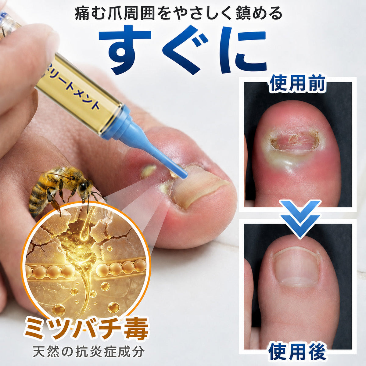🇯🇵 Trilumia® Fungi Free ビーベノム ネイルトリートメント 👨‍⚕️ – わずか7日で目に見える変化を実感